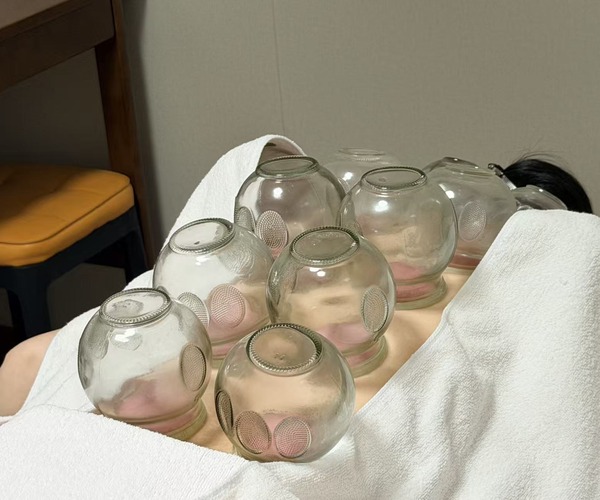 Cupping placement / 定罐